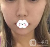 華西口腔醫(yī)院*多少錢？附術后果前后