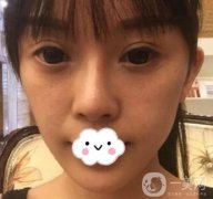 金華中心醫(yī)院整形科價格表及自體脂肪填充面部案例展示