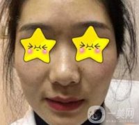 深圳北大醫(yī)院整形科價格表及自體脂肪填充面部果一覽