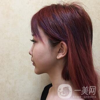 廣州曙光醫(yī)學(xué)美容醫(yī)院價(jià)格表及肋軟骨隆鼻案例分享