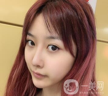 廣州曙光醫(yī)學(xué)美容醫(yī)院價(jià)格表及肋軟骨隆鼻案例分享