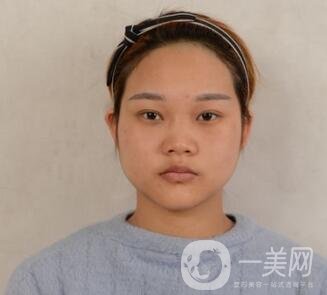 成都銅雀臺整形醫(yī)院隆鼻案例分享，附全新價格表