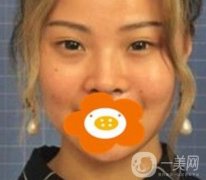 蚌埠美萊塢整形醫(yī)院玻尿酸隆鼻果如何？價格表2020年收費公布