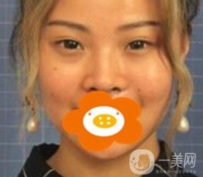 蚌埠美萊塢整形醫(yī)院玻尿酸隆鼻*果如何？價格表2020年收費公布