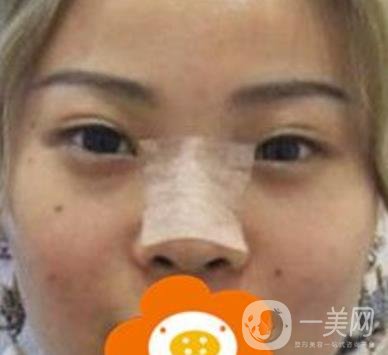 蚌埠美萊塢整形醫(yī)院玻尿酸隆鼻*果如何？價格表2020年收費公布