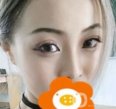 蚌埠美萊塢整形醫(yī)院玻尿酸隆鼻*果如何？價格表2020年收費公布
