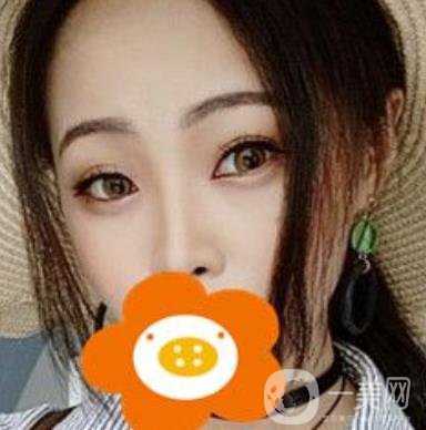 蚌埠美萊塢整形醫(yī)院玻尿酸隆鼻*果如何？價格表2020年收費公布