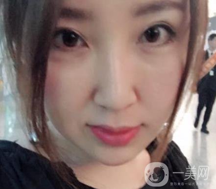 常州美貝爾整形美容醫(yī)院*注射多少錢？價格明細(xì)和*果圖展示