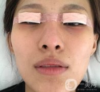 大連市中心醫(yī)院雙眼皮怎么樣？費用是多少？真人恢復經(jīng)歷自述