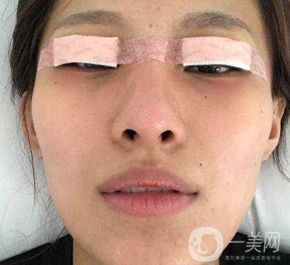 大連市中心醫(yī)院雙眼皮怎么樣？費(fèi)用是多少？真人恢復(fù)經(jīng)歷自述