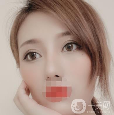大連市中心醫(yī)院雙眼皮怎么樣？費(fèi)用是多少？真人恢復(fù)經(jīng)歷自述