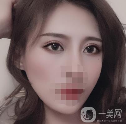 大連市中心醫(yī)院雙眼皮怎么樣？費(fèi)用是多少？真人恢復(fù)經(jīng)歷自述