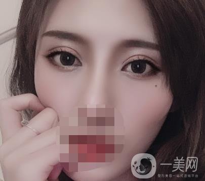 大連市中心醫(yī)院雙眼皮怎么樣？費(fèi)用是多少？真人恢復(fù)經(jīng)歷自述