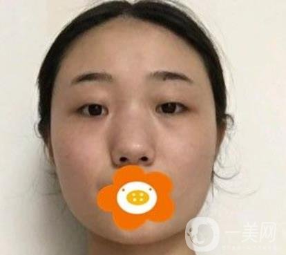 南京美貝爾整形醫(yī)院做*好不好？價格表費用明細和*果圖參考