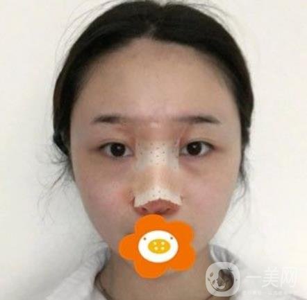 南京美貝爾整形醫(yī)院做*好不好？價格表費用明細和*果圖參考