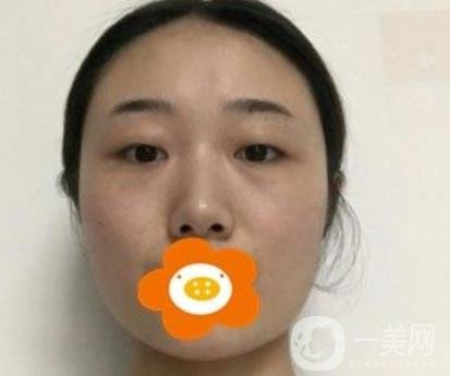 南京美貝爾整形醫(yī)院做*好不好？價格表費用明細和*果圖參考
