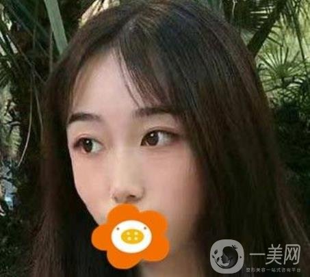 南京美貝爾整形醫(yī)院做*好不好？價格表費用明細和*果圖參考