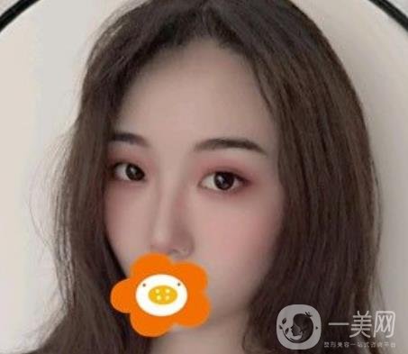 南京美貝爾整形醫(yī)院做*好不好？價格表費用明細和*果圖參考