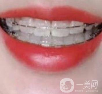 廣東省口腔醫(yī)院正畸價格表及案例恢復過程分享