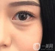 廣東省人民醫(yī)院整形科去眼袋怎么樣？?jī)?nèi)含案例及價(jià)格一覽表