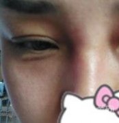 廣西醫(yī)科大一附院去眼袋怎么樣？整形價(jià)格表及案例果圖分享