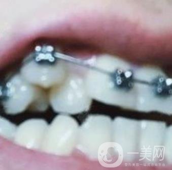 貴州口腔醫(yī)院正畸醫(yī)生信息介紹?內(nèi)含牙齒美容項(xiàng)目?jī)r(jià)格表及案例