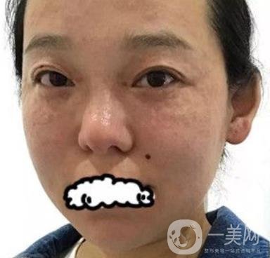 哈醫(yī)大四院整形美容科*新價(jià)格表公布,附祛斑真人案例