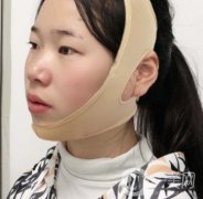 南京鼓樓醫(yī)院整形科價格表（價格）,及磨骨阿案例日記分享