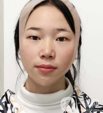 南京鼓樓醫(yī)院整形科價格表（價格）,及磨骨阿案例日記分享
