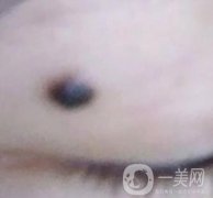 青醫(yī)附院王彥進去痣怎么樣？價格表及果展示