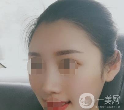 青醫(yī)附院王彥進去痣怎么樣？價格表及*果展示