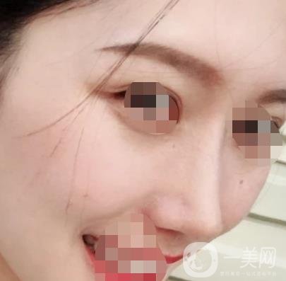 青醫(yī)附院王彥進去痣怎么樣？價格表及*果展示