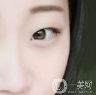 沈陽百嘉麗醫(yī)院價(jià)格表2020，附雙眼皮案例分享