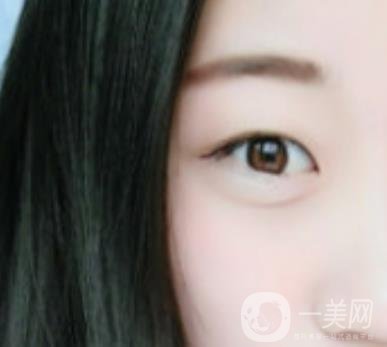 沈陽百嘉麗醫(yī)院價(jià)格表2020，附雙眼皮案例分享