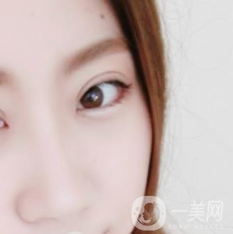 沈陽百嘉麗醫(yī)院價(jià)格表2020，附雙眼皮案例分享