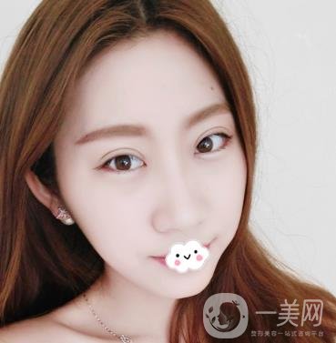 沈陽百嘉麗醫(yī)院價(jià)格表2020，附雙眼皮案例分享