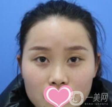 沈陽名流整形醫(yī)院價(jià)格表，附雙眼皮+隆鼻案例