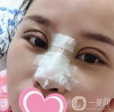 沈陽名流整形醫(yī)院價(jià)格表，附雙眼皮+隆鼻案例