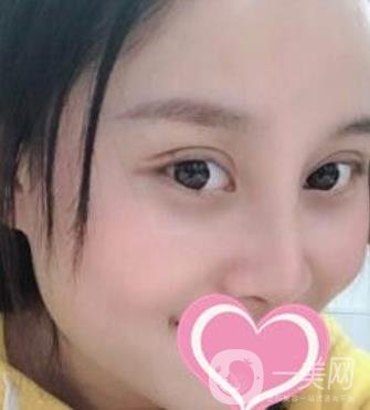沈陽名流整形醫(yī)院價(jià)格表，附雙眼皮+隆鼻案例