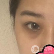 沈陽杏林整形醫(yī)院割雙眼皮果咋樣?看實例及價格表