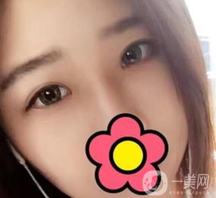 沈陽(yáng)杏林整形醫(yī)院割雙眼皮*果咋樣?看實(shí)例及價(jià)格表