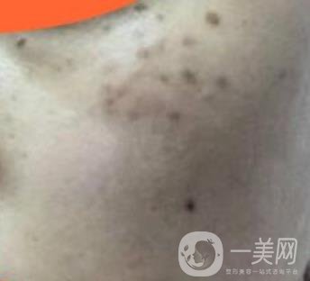 沈陽伊美爾整形醫(yī)院價格表，附祛斑*果展示