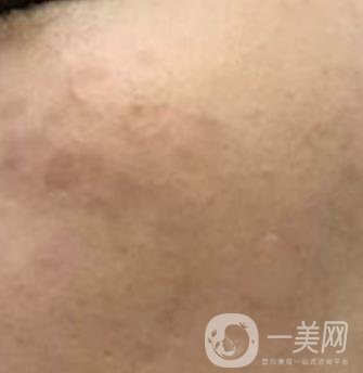 沈陽伊美爾整形醫(yī)院價格表，附祛斑*果展示