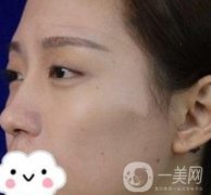 臺州博雅美惠醫(yī)療美容整形雙眼皮恢復(fù)日記，內(nèi)附價格表明細