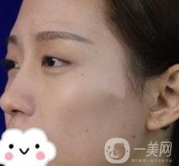 臺州博雅美惠醫(yī)療美容整形雙眼皮恢復(fù)日記，內(nèi)附價格表明細