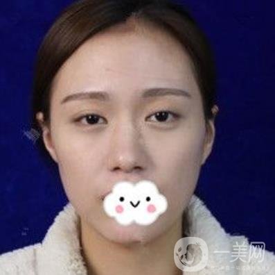 臺州博雅美惠醫(yī)療美容整形雙眼皮恢復(fù)日記，內(nèi)附價格表明細