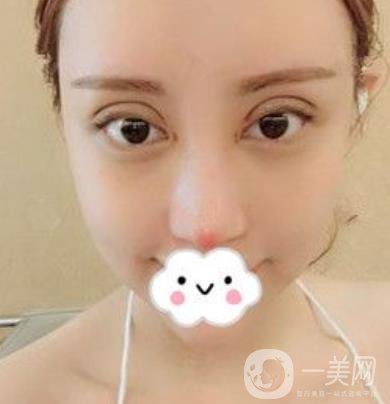 臺州博雅美惠醫(yī)療美容整形雙眼皮恢復(fù)日記，內(nèi)附價格表明細