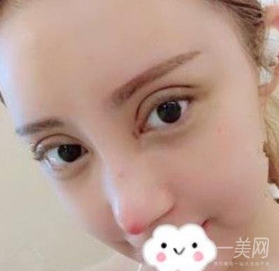 臺州博雅美惠醫(yī)療美容整形雙眼皮恢復(fù)日記，內(nèi)附價格表明細