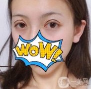 武漢艾萊美醫(yī)療整形醫(yī)院價格表項目收費明細，附雙眼皮案例