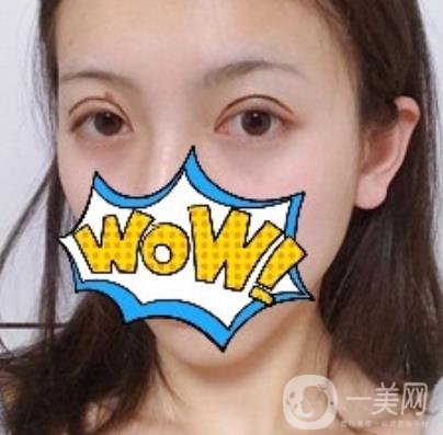 武漢艾萊美醫(yī)療整形醫(yī)院價(jià)格表項(xiàng)目收費(fèi)明細(xì)，附雙眼皮案例